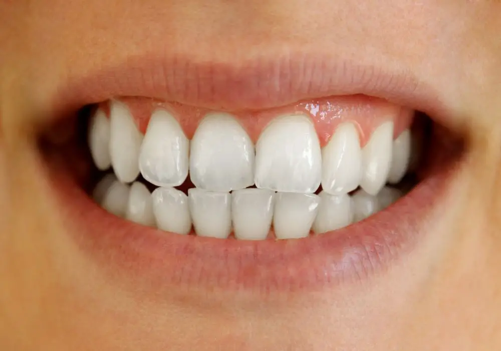 Are Permanently Straight Teeth Possible After Braces