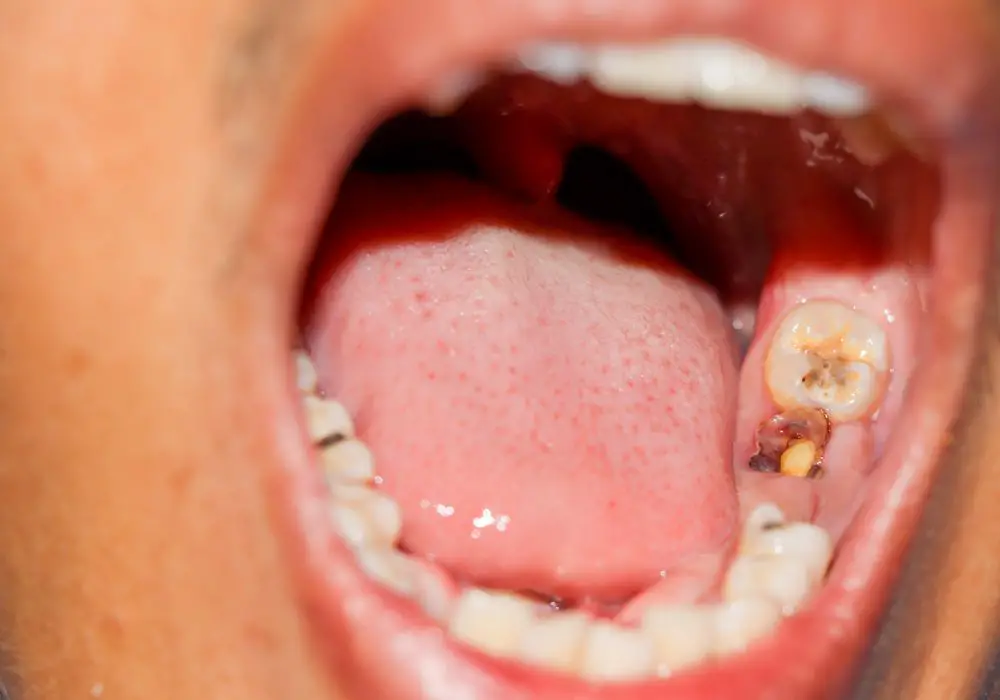 Are White Spots an Indication of Cavities