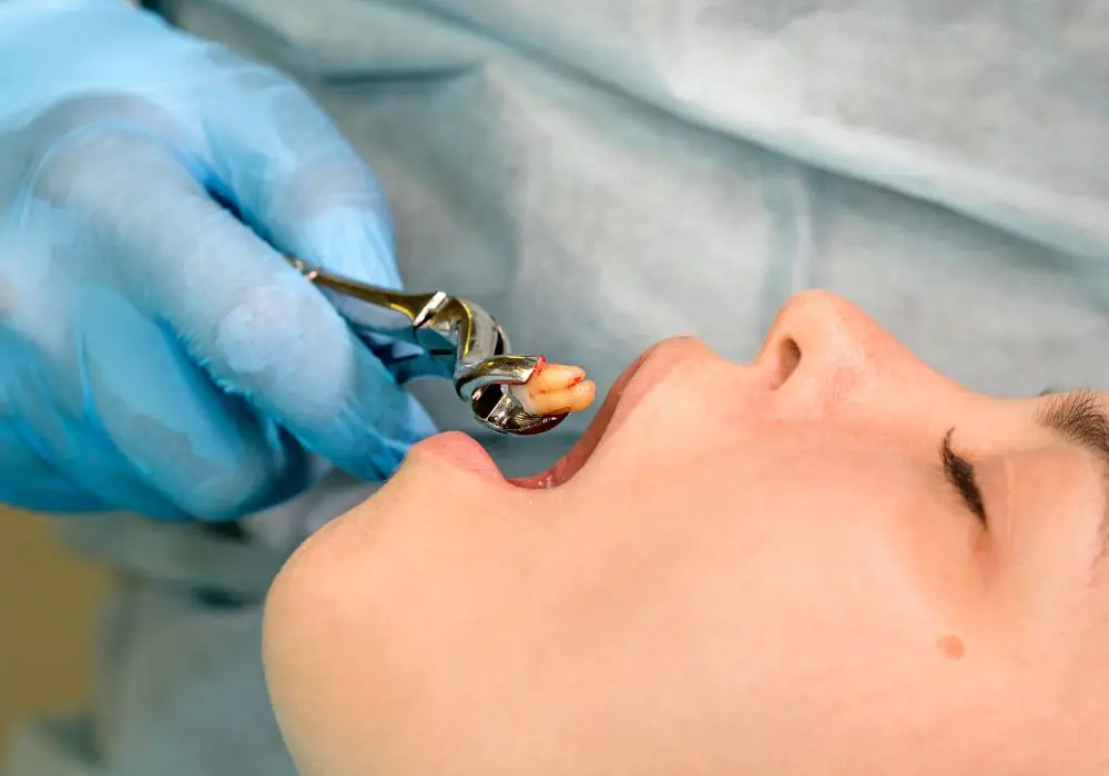 Are blood clots normal after wisdom tooth removal?