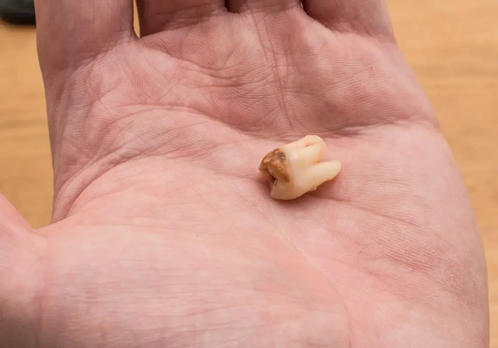 Are there alternatives to wisdom tooth extraction?
