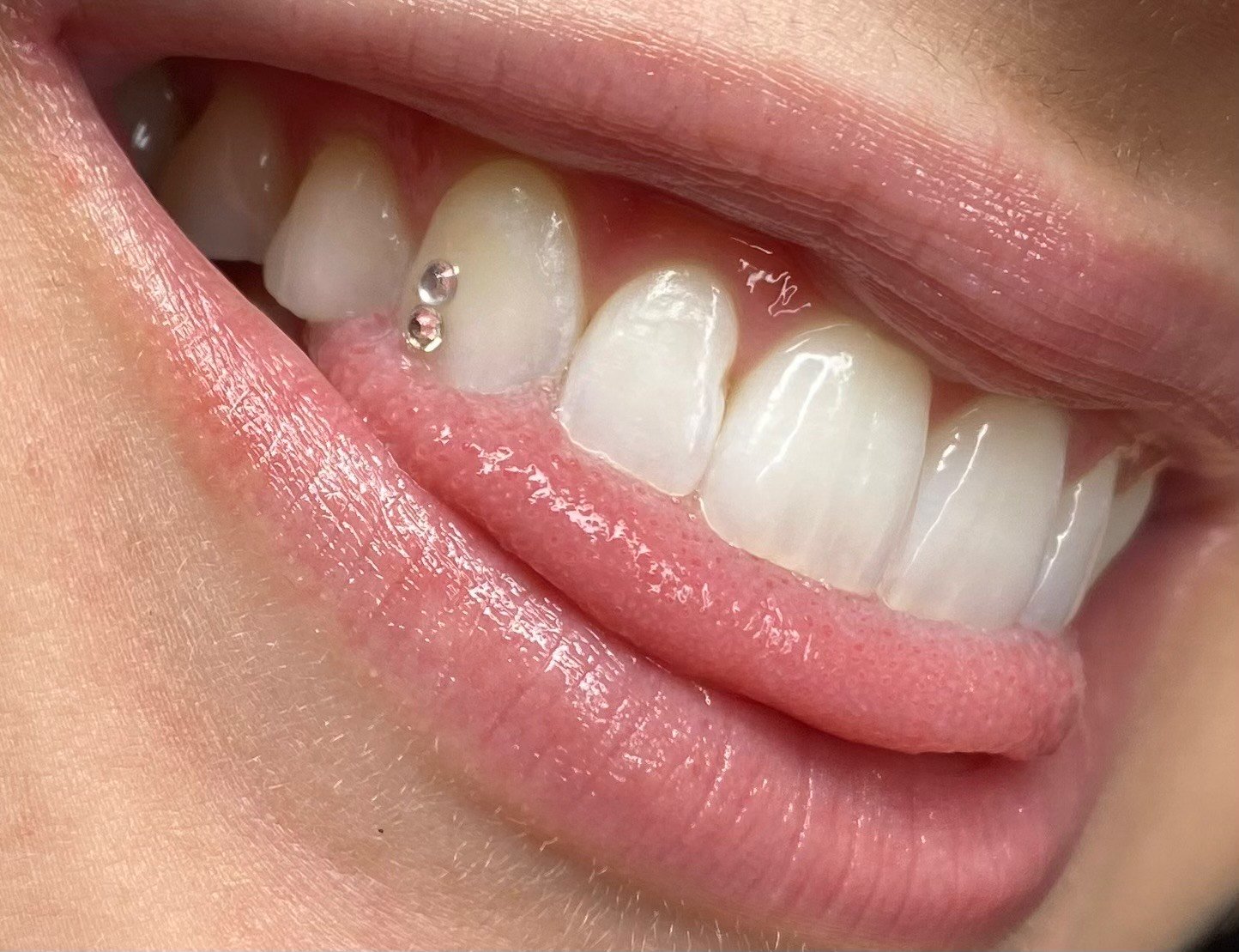 The Dangers of Tooth Gems - Stensland Dental Studio