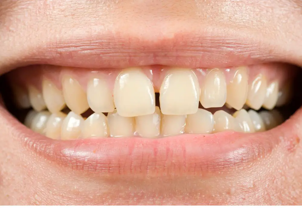 Are white crowns and fillings better than natural shade?