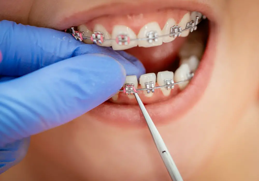 At what point during treatment do teeth start to stain