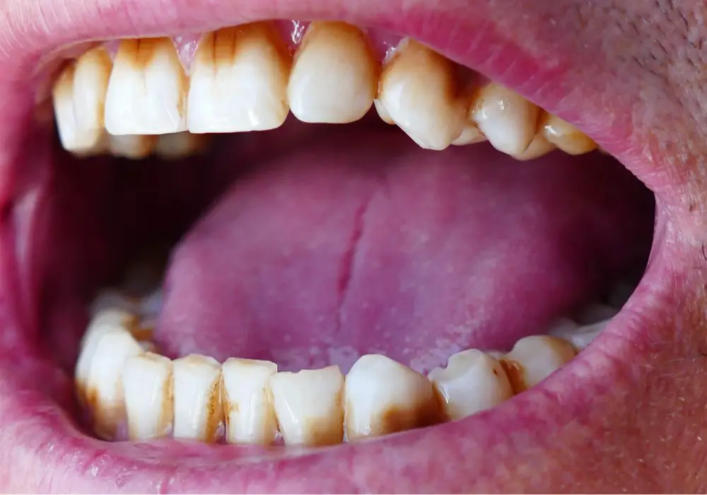 Available Treatment Options for Black Tooth Staining