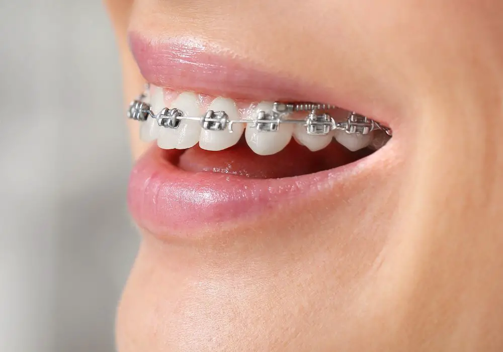 Braces and Dental Implants