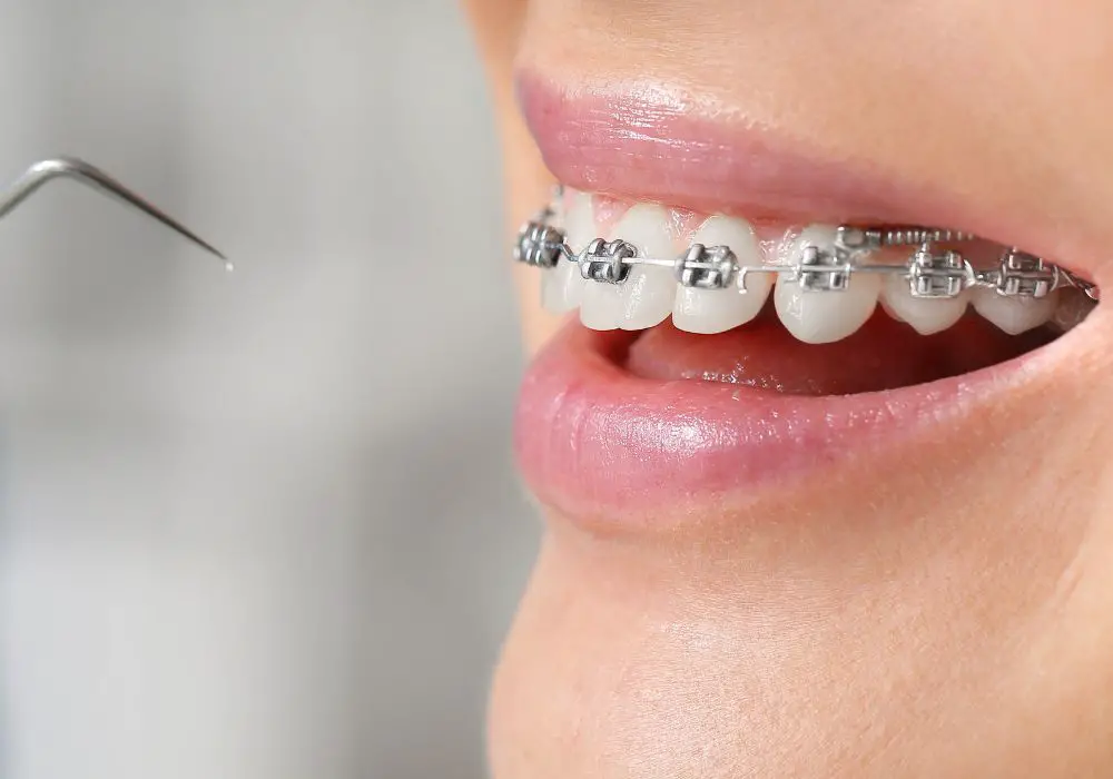 Braces and Tooth Movement