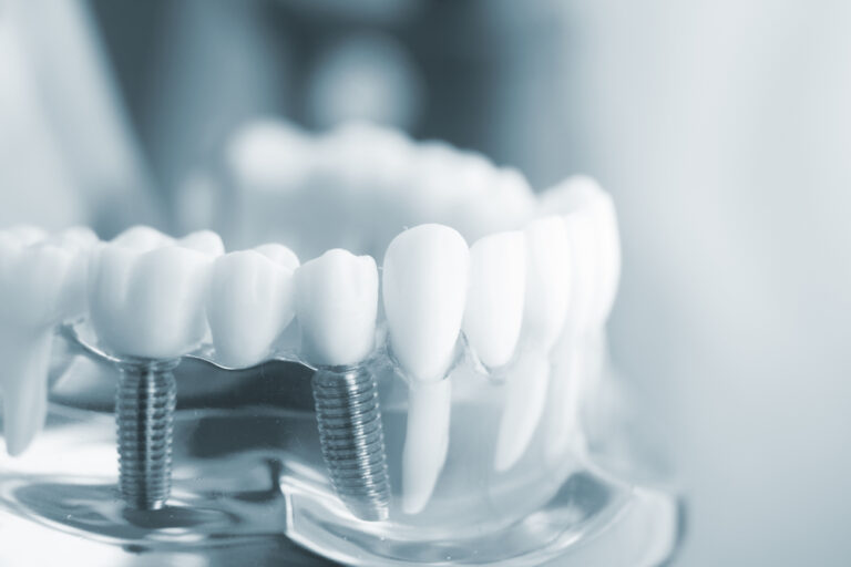 Can 2 implants support 6 teeth? Find out the success-rates!