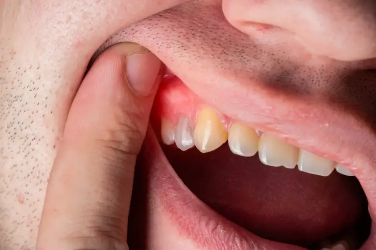 Can A Tooth Be Saved If Infected? (Ultimate Guide)