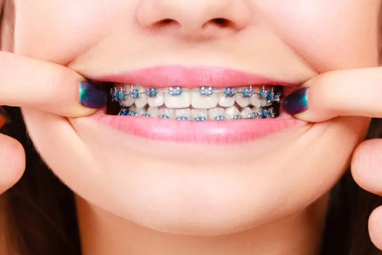 Can Braces Push a Long Tooth Further into the Gums? Exploring the Relationship between Braces and Long Teeth