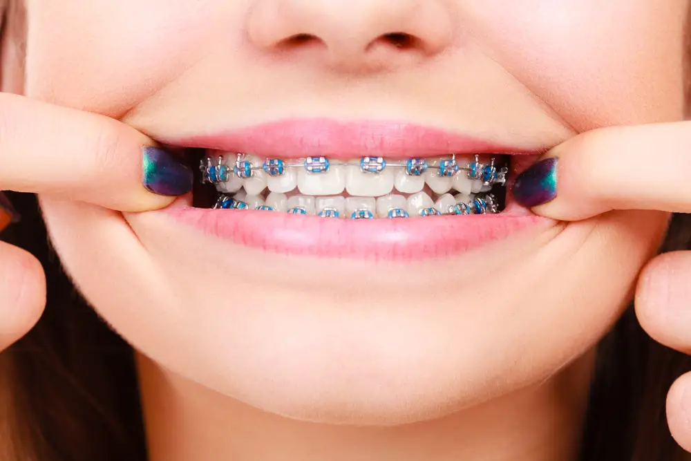 Can Braces Push a Long Tooth Further into the Gums? Exploring the