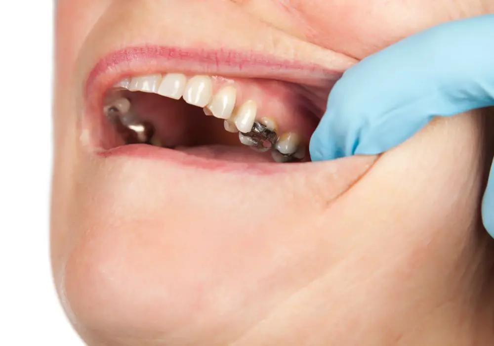Can Cutting Sugar Benefit Dental Implants?