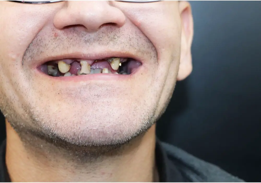 Can Decayed Front Teeth Be Saved with Fillings?