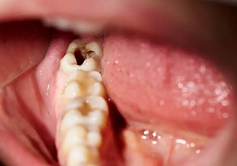 Can Holes In Teeth Heal Naturally? (Everything You Need To Know)