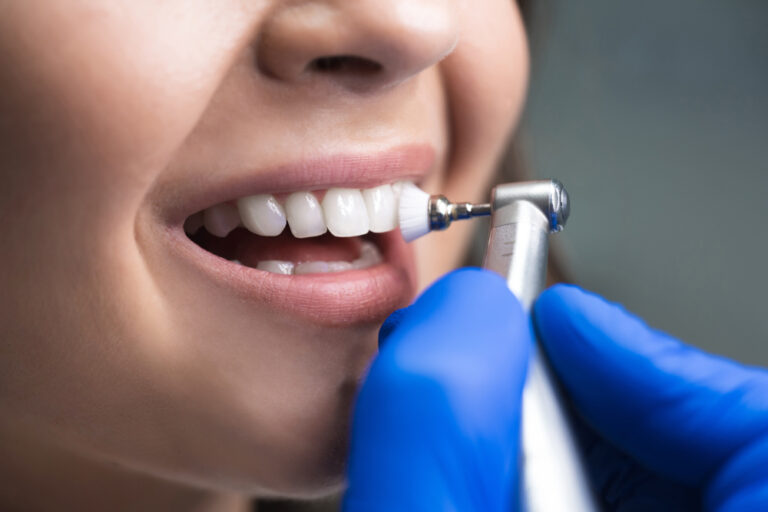 Can I Get My Teeth Cleaned On NHS? (Ultimate Guide)