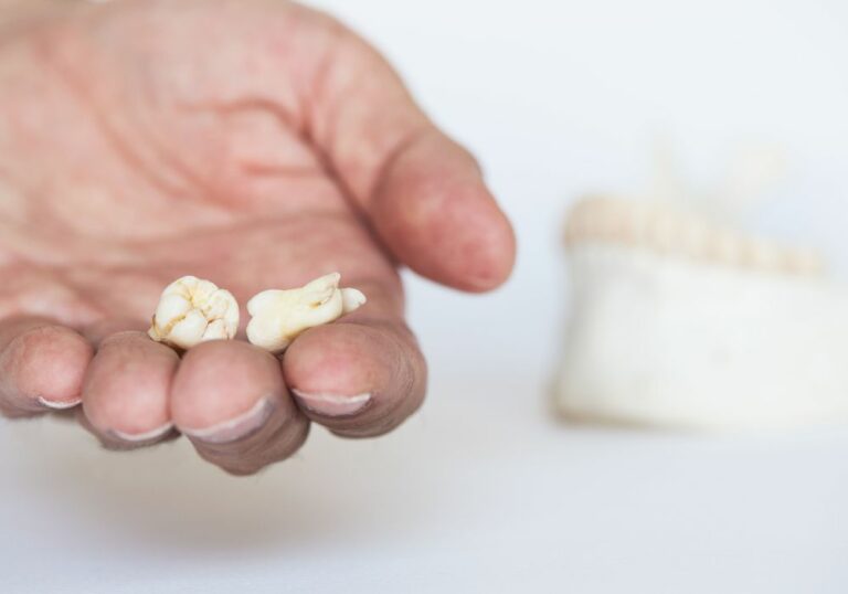 Can I Eat Normally With Wisdom Teeth Holes? (Ideal Foods)