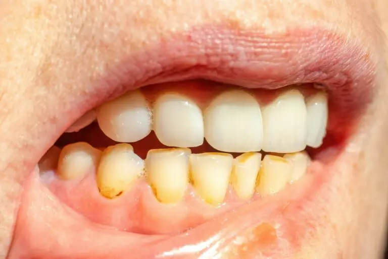 Can I Remove Calculus From My Teeth? (Calculus Removal Techniques)