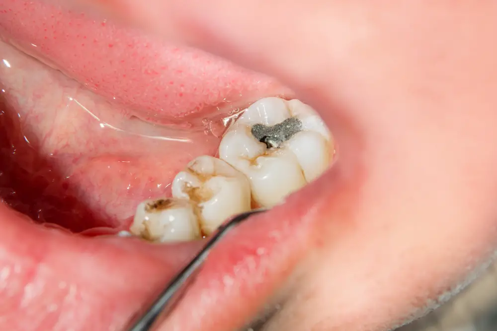 Can One Rotten Tooth Affect Others? Exploring the Connection Between Dental  Health and Overall Wellness