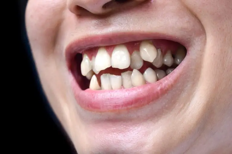 Can Overcrowding Teeth Be Fixed? Tips and Advice