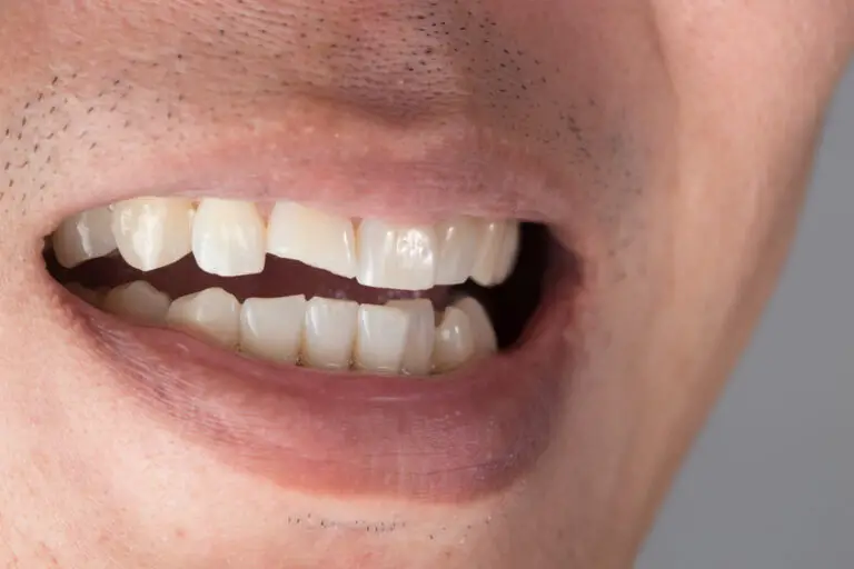 Can Permanent Teeth Break? (Trigger factures, Treatments & Prevention)