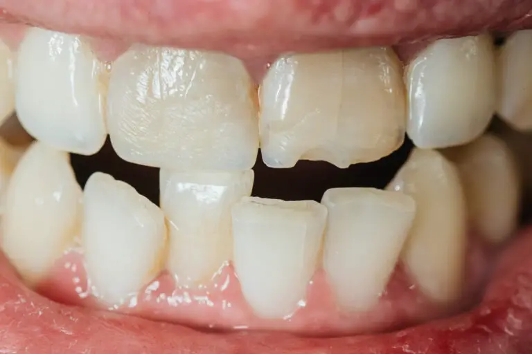 Can Small Chips In Teeth Be Fixed? (Causes, Treatments & Preventions)
