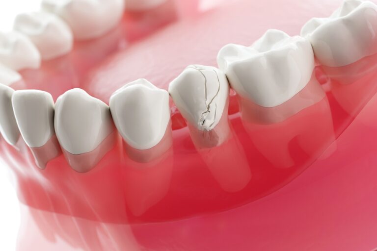 Can Teeth Crack from Thermal Shock? Understanding the Causes and Prevention