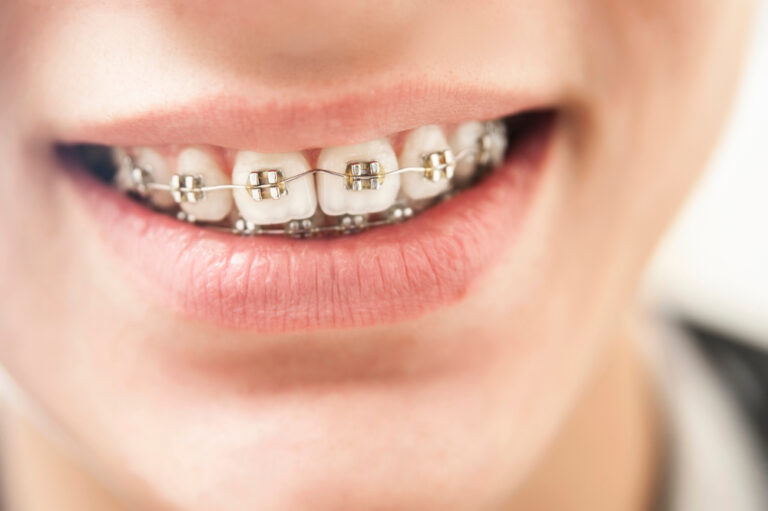 Can Teeth Fall Out After Braces? Here’s What You Need to Know