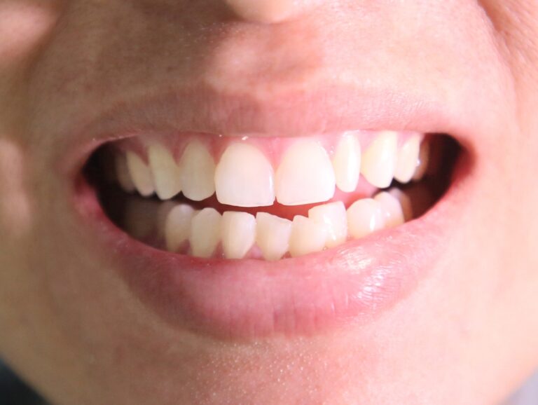 Can Teeth Grinding Cause Overbite? (Causes, Influence & Treatments)