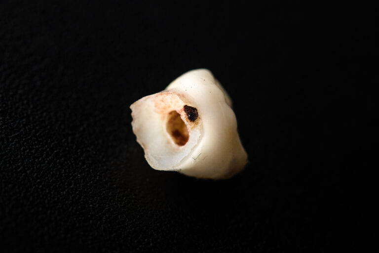 Can Teeth Holes Heal Themselves? Exploring the Possibility