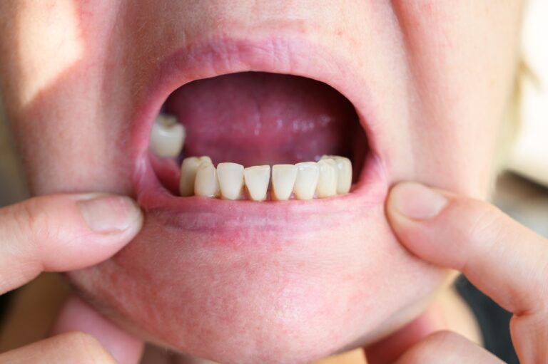 Can Teeth Shift Suddenly? (Causes, Signs & Mentainance)