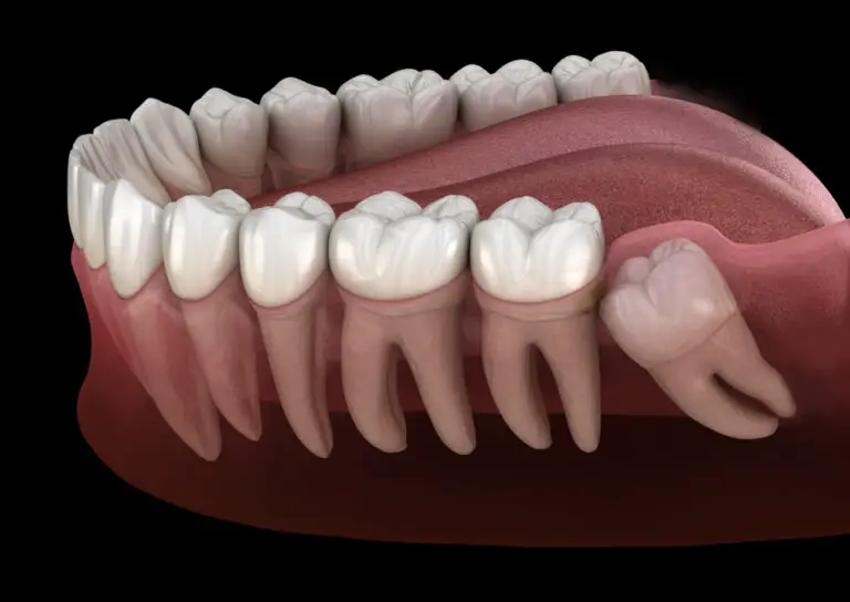 Can Wisdom Teeth Removal Cause Other Teeth to Move? Exploring the Potential Side Effects