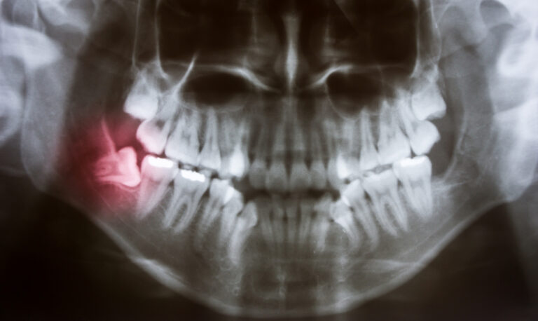 Can Wisdom Teeth Shift Your Jaw? Exploring the Connection