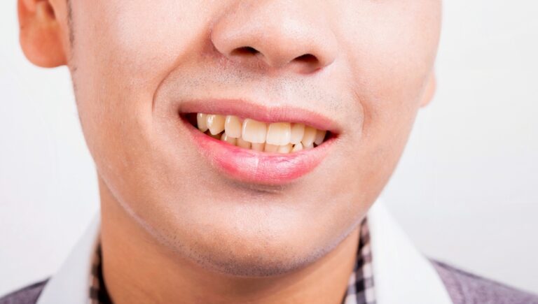 Can Yellow Teeth Be Removed? Tips and Tricks to Brighten Your Smile