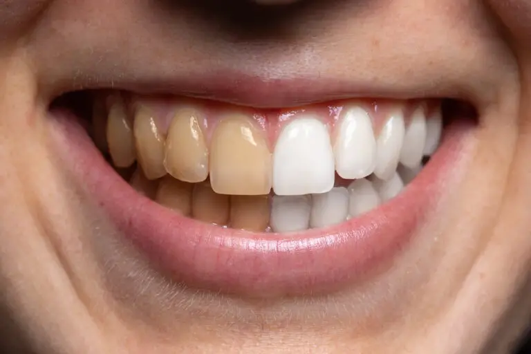 Can You Fix Badly Stained Teeth? (Causes & Whitening Options)
