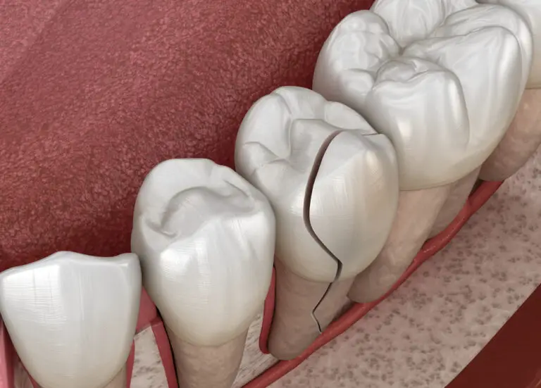 Can You Fix Chipping Teeth? Tips and Options to Consider