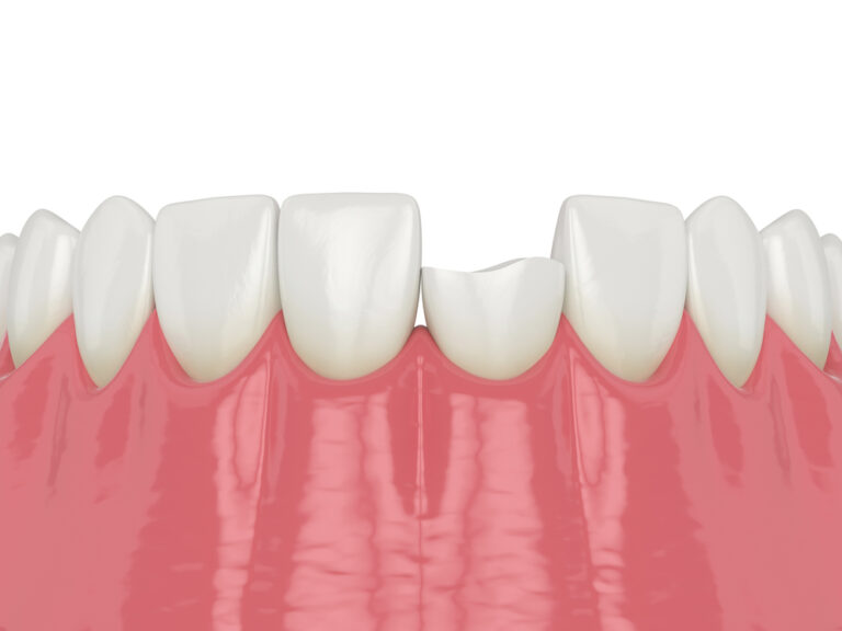 Can You Fix a Chipped Tooth Without a Veneer? Exploring Your Options