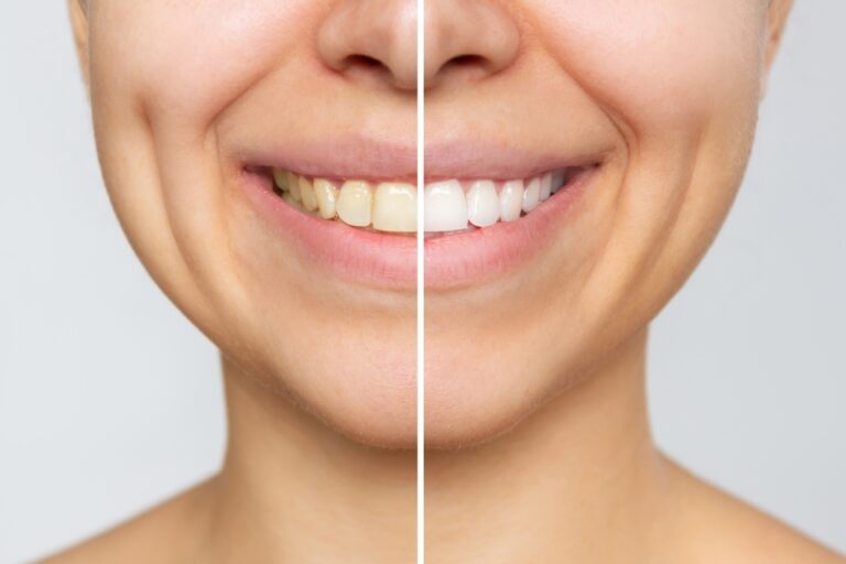 Can You Get Grey Teeth White? Professional Options & Home Remedies