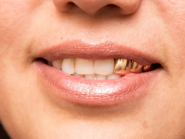 Can You Get Money for a Gold Tooth? Exploring Your Options