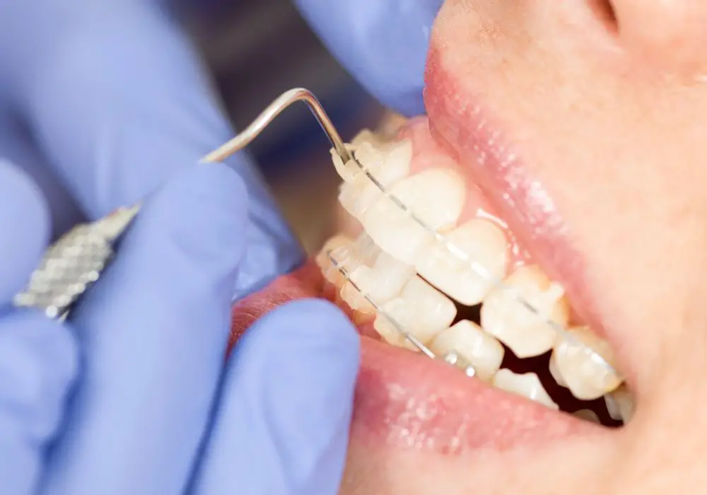 Can You Get Tooth Gems Around Braces?