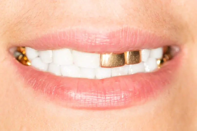 Gold Tooth Replacement: Can You Replace a Missing Tooth with a Gold Tooth?
