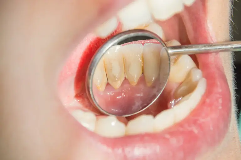 Can You Reverse Plaque On Teeth? (8 Effective Ways)