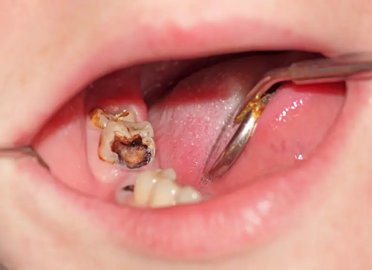 Can a Badly Decayed Tooth be Saved? Tips from a Friendly Dentist