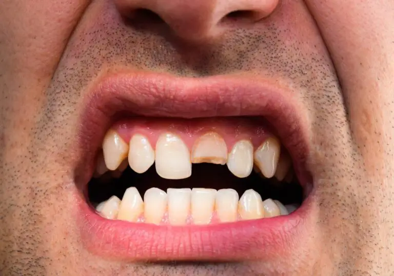 Can a Dentist Fix a Tooth Broken in Half? Here’s What You Need to Know