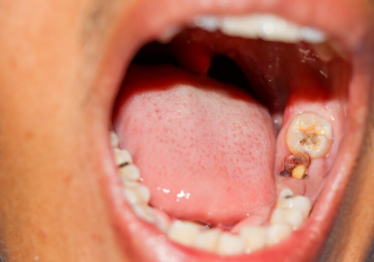 Can A Dentist Fix Damaged Teeth? (Dental Procedures)
