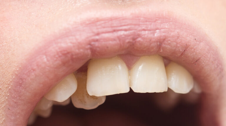 Can A Slightly Chipped Tooth Heal? (Causes & Treatments)