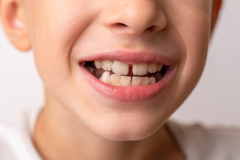 Can A Tooth Gap Go Away Naturally? (Causes & Treatments)