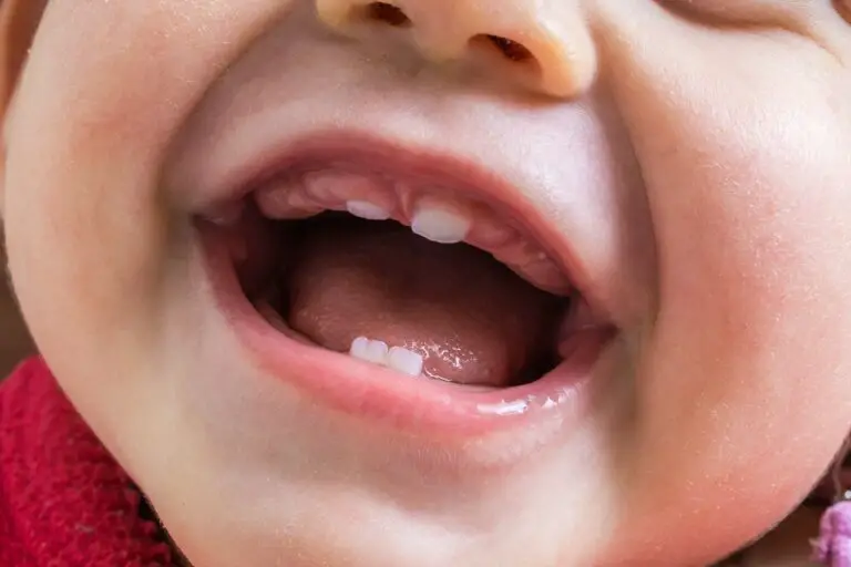 Can Baby Teeth Come in the Wrong Place? Exploring Misaligned Baby Teeth