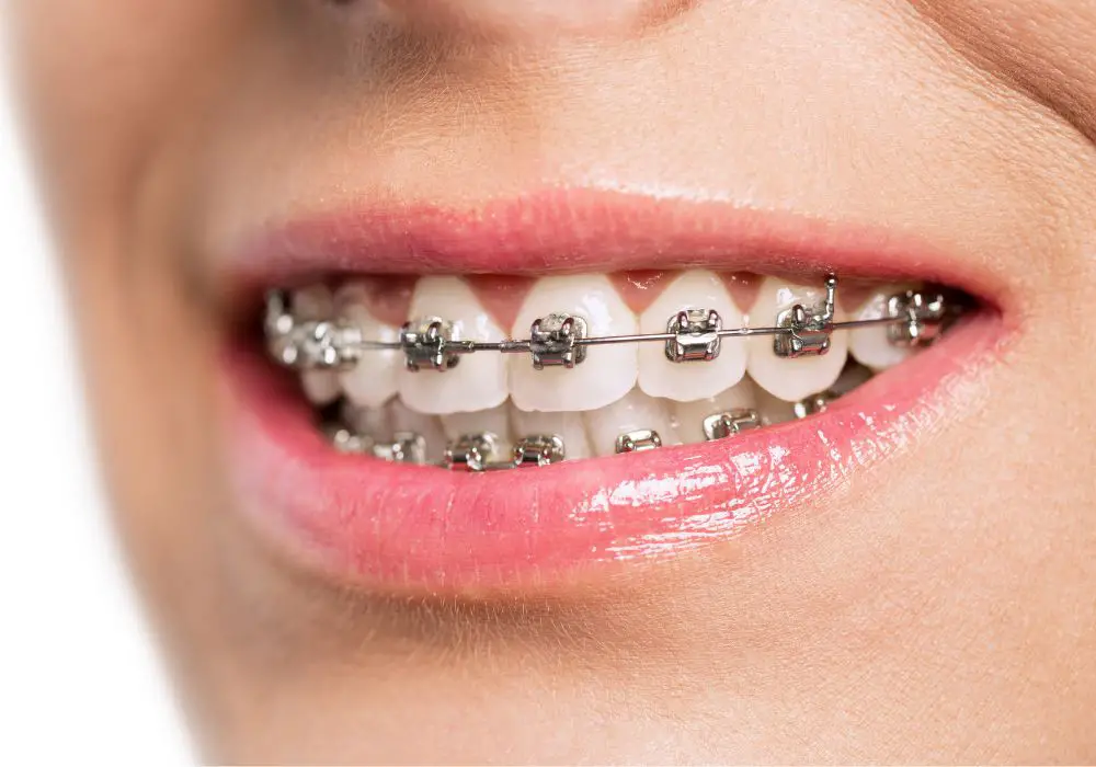 Can braces literally break teeth?