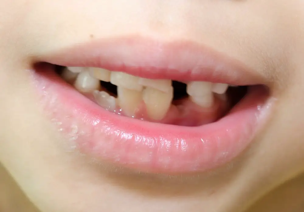Can chipped and cracked teeth heal on their own?