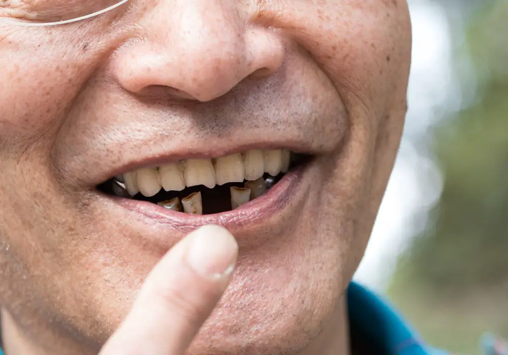 Can Dark Brown Stains Be Removed From Teeth? (Professional Whitening