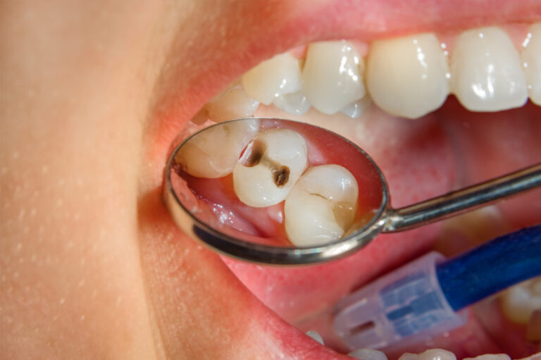 Can decaying teeth be restored? Dental treatment options for you!